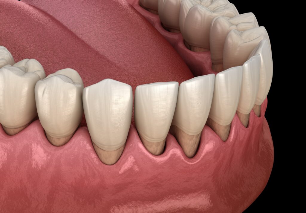 A detailed 3D rendering of human teeth and gums, illustrating an inside view of the lower jaw with realistic textures and colors, subtly highlighting early signs of gum disease against a black background.