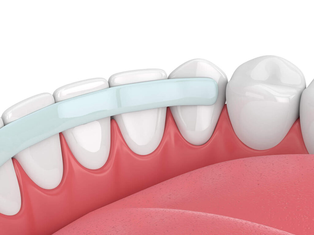 Illustration of a dental bonding