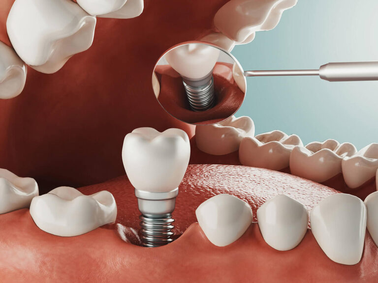A 3D illustration shows a dental implant process. A tooth implant with a crown is placed into the gum, surrounded by natural teeth. A magnified view highlights the screw-like implant base being inserted into the gum.